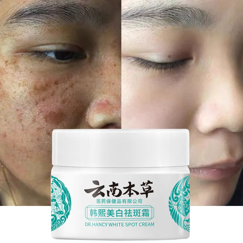 

20g Yun Nan Herb Powerful Whitening Freckle Cream Remove Acne Spots Melanin Dark Spots Face Moisturizing Face Skin Care Beauty