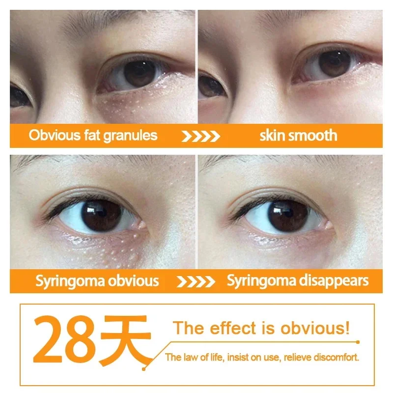 Fat Granules Removal Eye Serum Anti Dark Circle Eye Bags Fade Fine Line Essence Anti-Puffiness Moisturizing Skin Care Products