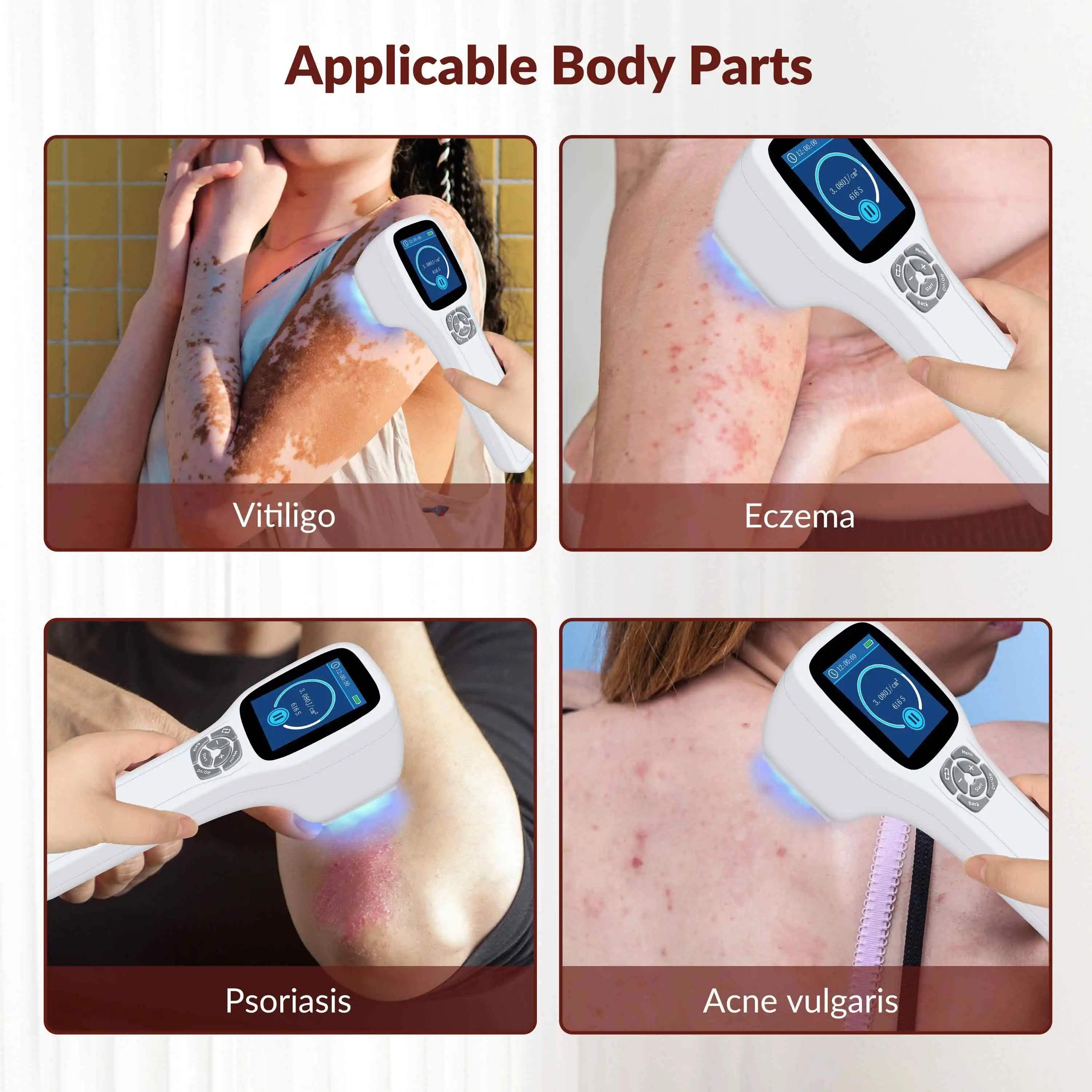 

ZJZK 308nm Excimer UVB Light Lamp Narrowband Ultraviolet UV Treatment for Vitiligo Psoriasis EczemaGOOD