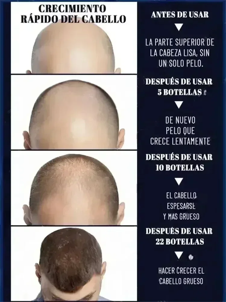 Hot sale, buyers will buy again, hair is getting more and more, say goodbye to baldness, sparse hair starts to become thick.2005