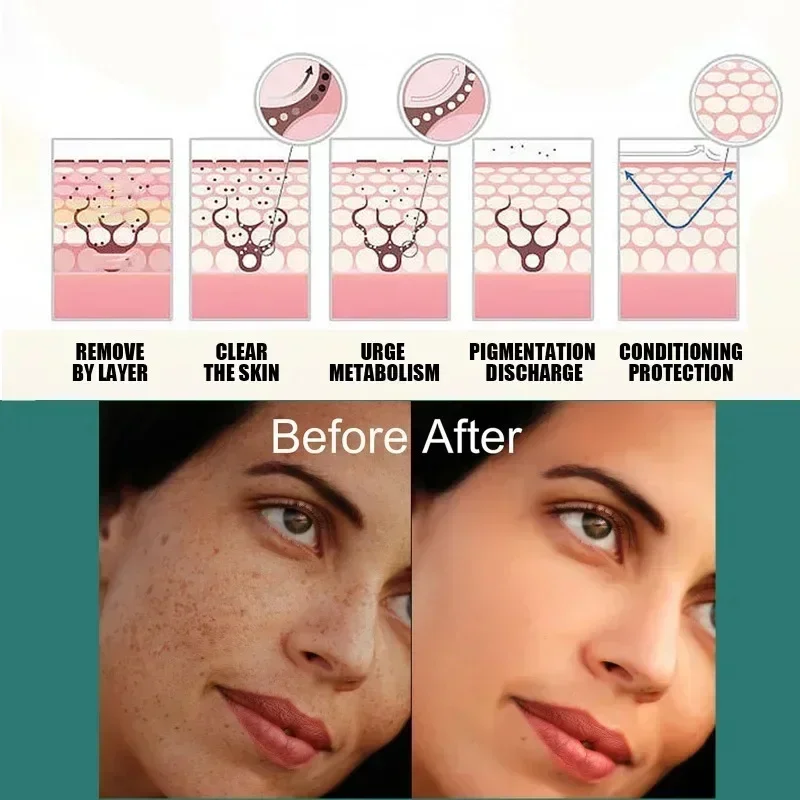 Niacinamida Clareamento Creme De Sardas, Remover Melasma, Mancha Escura Clarear, Melanina Iluminar, Reparação Hidratante, Produtos De Cuidados Com A