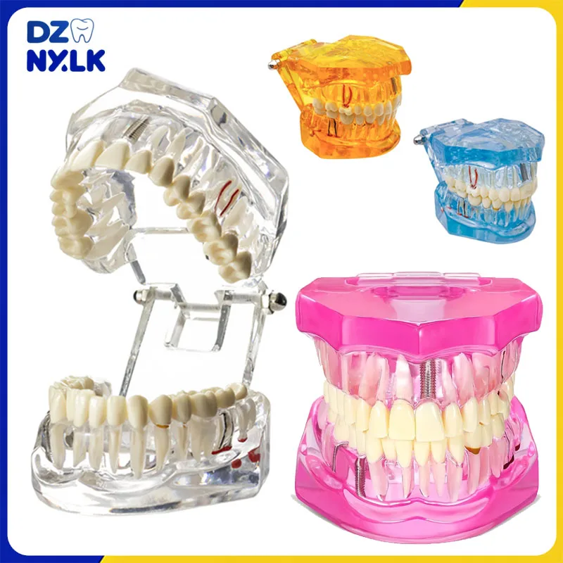 1Pc Dental Model Teeth Implant Restoration Bridge Disease Removable Teeth Model Dentist Education Demonstration Gift Demo Model