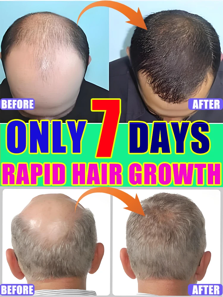 Rᴀᴘɪᴅ ɢʀᴏᴡᴛʜ ʜᴀɪʀʟɪɴᴇ ᴄᴀʀᴇ sᴄᴀʟᴘ から髪の毛包の抜け毛を防ぐエッセンス