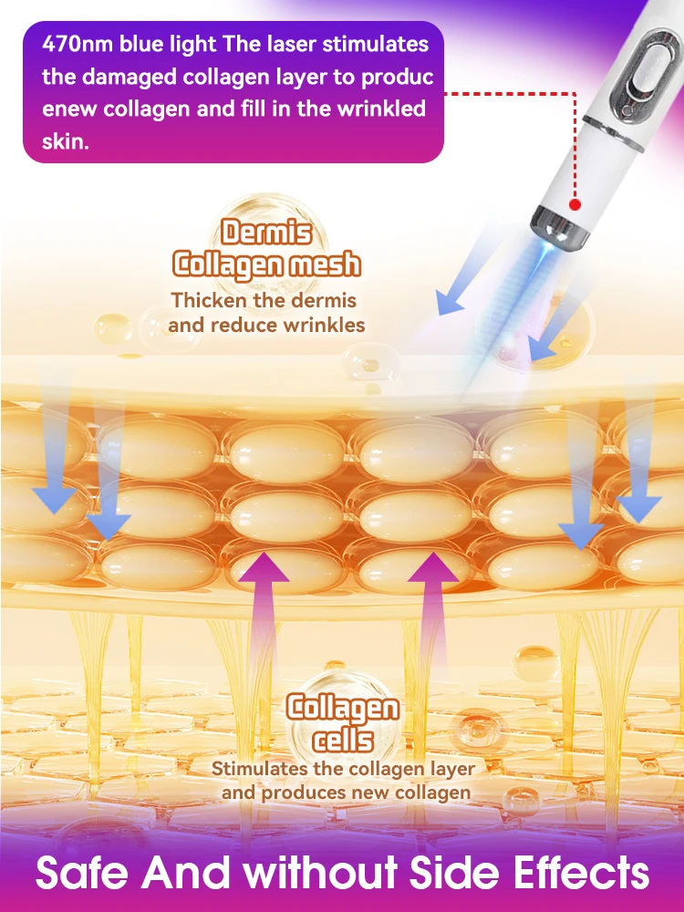 Blaulichtstift zur Reparatur von Gesichtsfalten