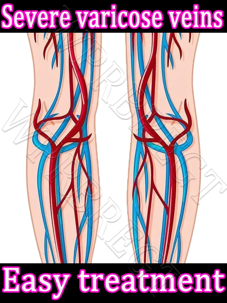 

The second generation relieves leg phlebitis and dilated vasculitis, avoiding surgical pain