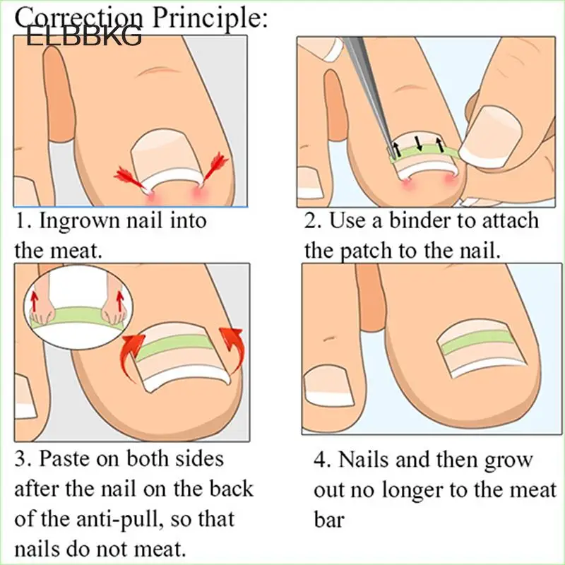 10pc/box Ingrown Toenail Correction Tool Ingrown Toe Nail Treatment Elastic Patch Sticker Straightening Clip Brace Pedicure Tool