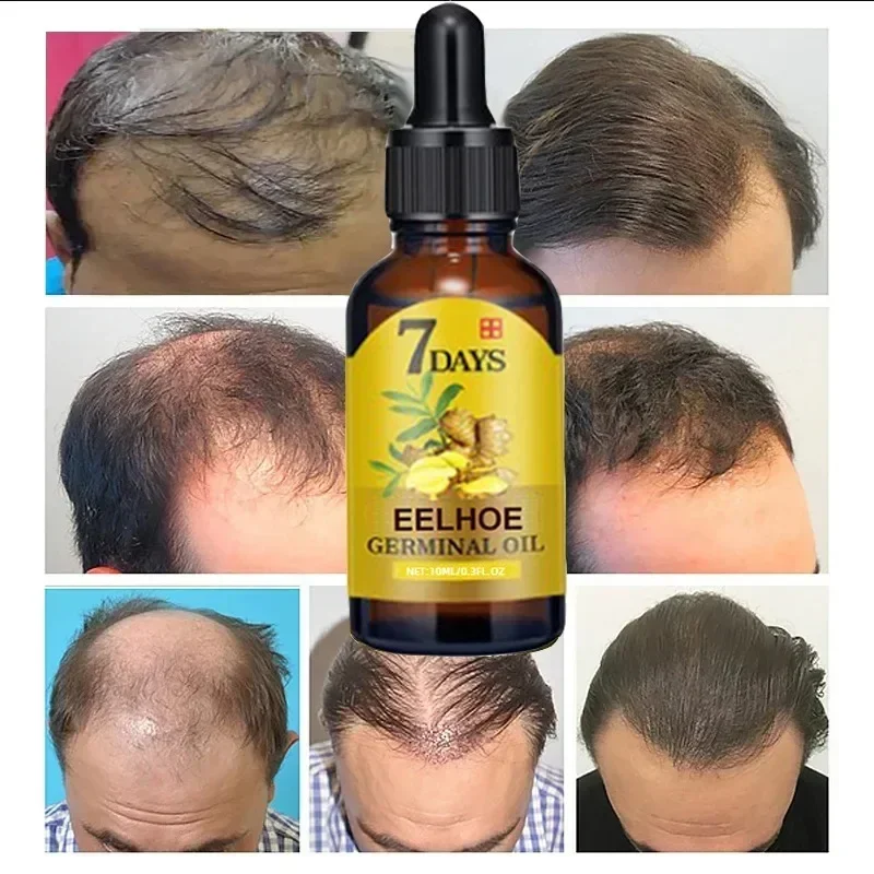 Óleo de crescimento rápido do cabelo para homens e mulheres, anti perda de cabelo, tratamento do couro cabeludo, produtos de soro, beleza, saúde, gengibre