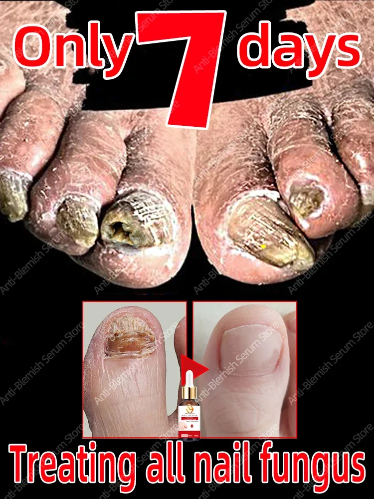 

nail fungus（Buy 2 and get 1 free, buy 3 and get 2 free, buy 5 and get 5 free, support wholesale）