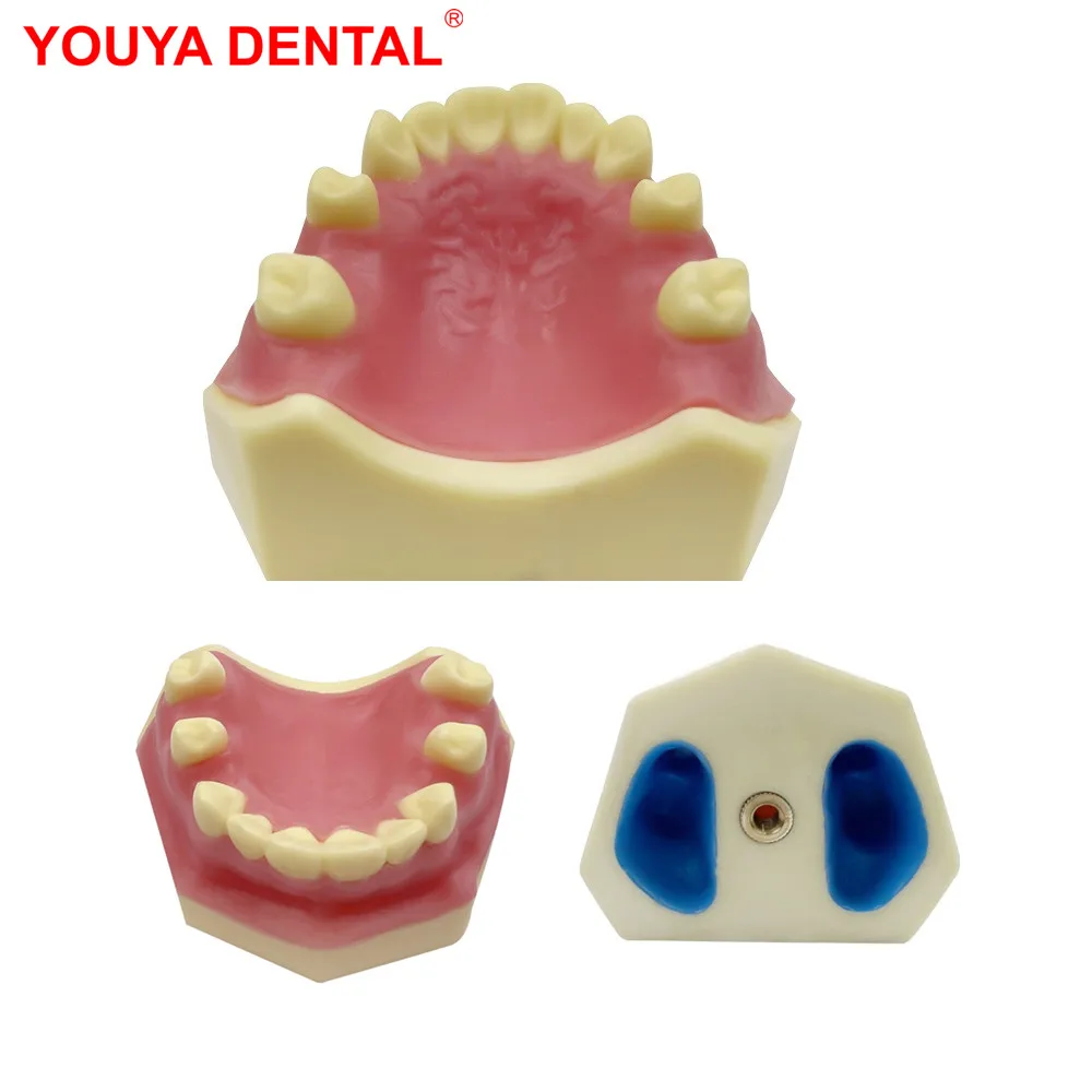 

Teeth Model Implant Practice Dental Model Teeth Teaching Model For Dental Students Dentist Studying Training Examation Dentistry