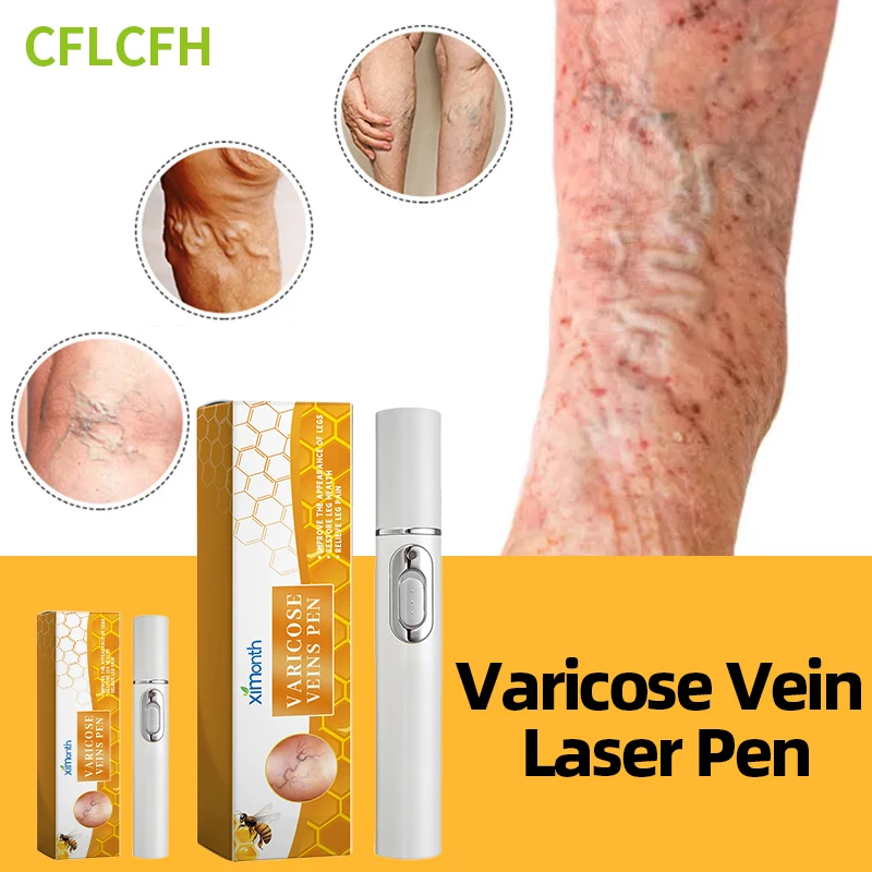 Varicose Veins Laser Therapy Pen Improves Moderate Varicose Vein Relieve Leg Pain For Men And Women Improve Blood Circulation