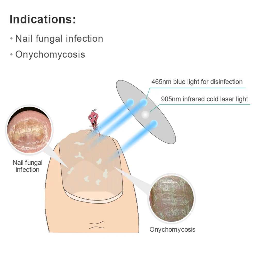 

Nail Fungus Laser Treatment Device for Nails with Mushrooms Repair Toenail Fingernail Fungus Treat Onychomycosis Ingrown Toenail