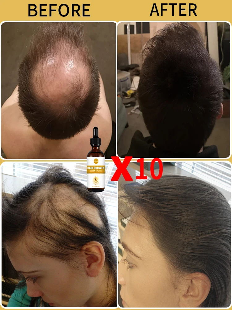 اشتر 5 واحصل على 5 مجانًا من زيت الشعر العضوي المبيعات الساخنة، مناسب للشعر الكثيف والطويل عرض خاص