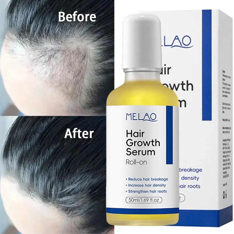 

Fast Hair Growth Serum 7 Days Anti Hair Loss Prevent Baldness Scalp Treatment Repair Roots Beauty Health Hair Care For Men Women