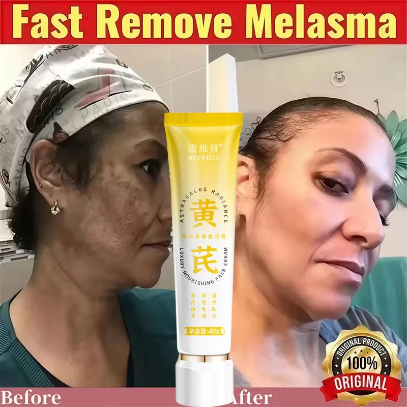 Potente crema blanqueadora para eliminar manchas de pecas, elimina el melasma, manchas oscuras, decoloración, pigmentación, acné, brillo hidratante, cuidado de la piel