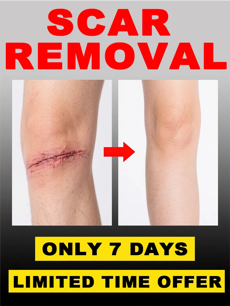 

ᵀʰᵉ ᵍᵒˡᵈᵉⁿ ᵖᵉʳⁱᵒᵈ ᶠᵒʳ ʳᵉᵖᵃⁱʳ ⁱˢ ʷⁱᵗʰⁱⁿ 6 months after the formation of new scars.