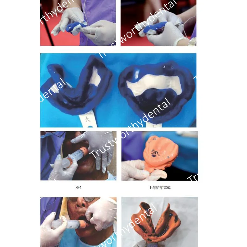 Dental Impression Tray Soft Aluminum L/M/S Detachable No Pressure Bend Trays 2-Layer Upper Teeth Lower Teeth