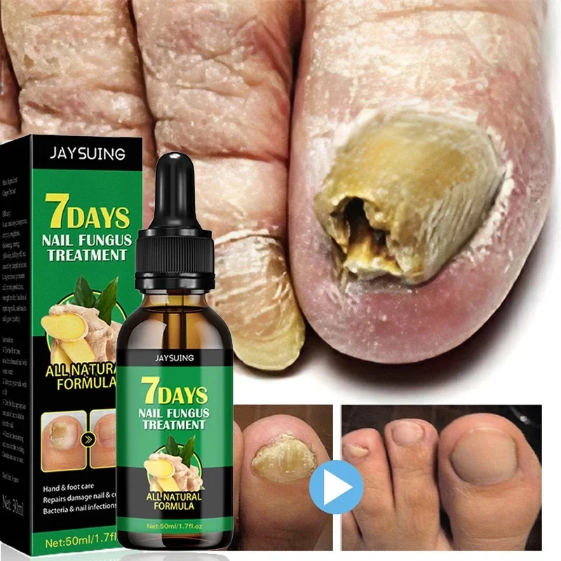 

7 Days Nail Fungal Treatment Essence Oil Foot Toe Nail Fungus Removal Serum Repair Onychomycosi Anti Infection Gel Care Products