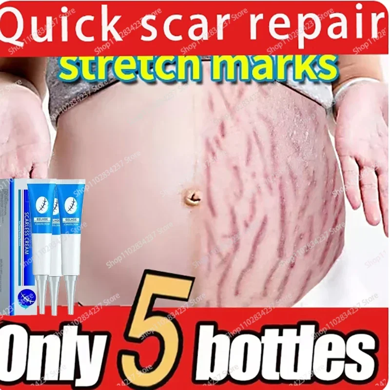 

Eliminate Red White Old Stretch Marks Cream For Pregnancy Postpartum Skin Care