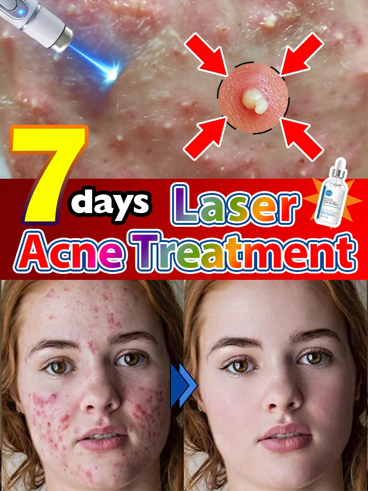 

Highly efficient nano-laser repairs facial acne