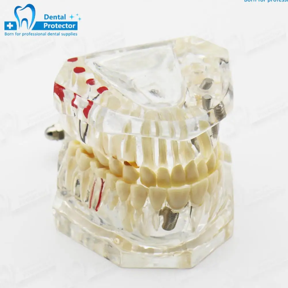

Dental Models Removable And Restorable Models Of Diseased Teeth For Teaching And Researching Medical And Dental Diseases