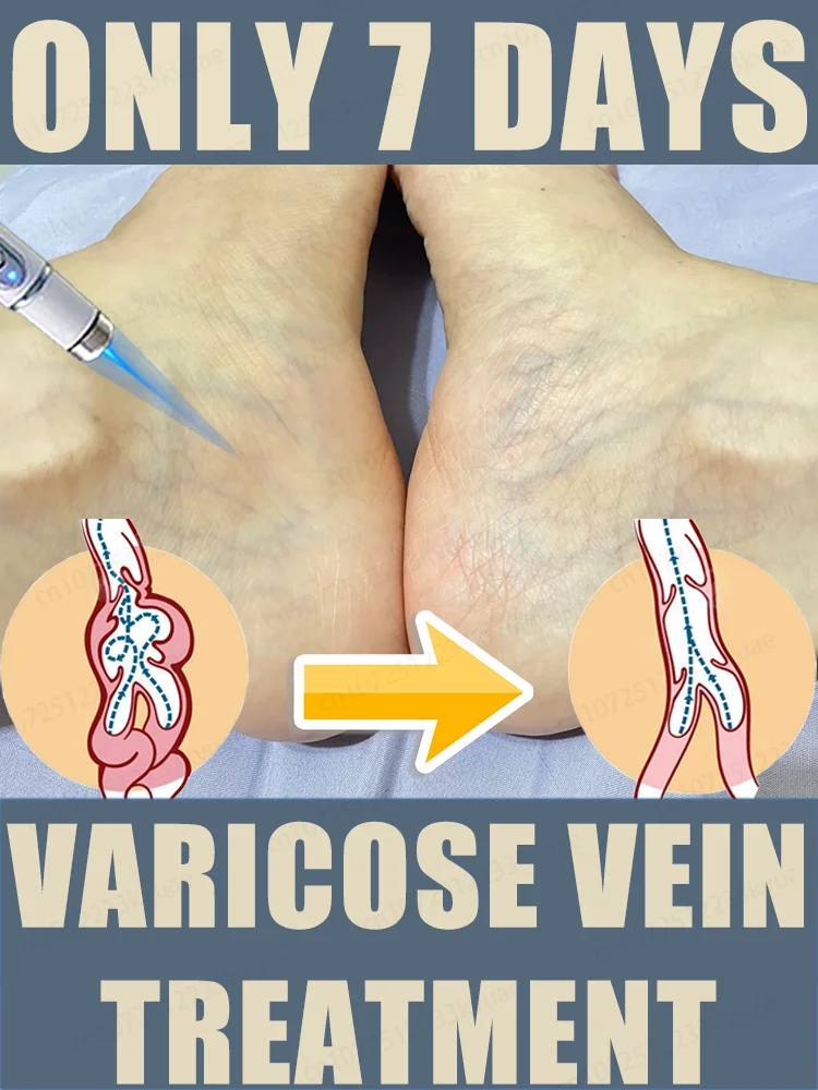 

Laser treatment for varicose veins,ᴍᴇᴅɪᴄᴀʟ grade equipment, painless treatment for spider veins and blood in the legs