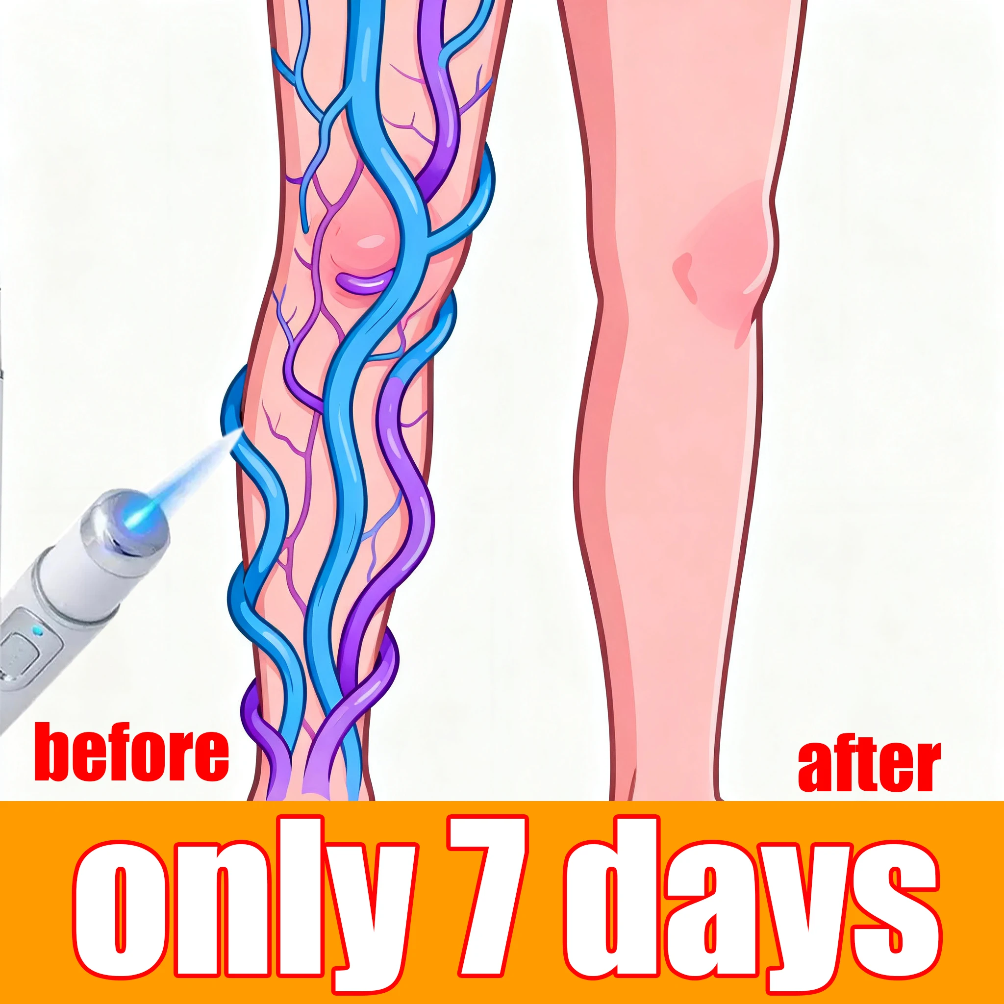 

Лазерная ручка для удаления варикозного расширения вен, инструмент для ухода за ногами.