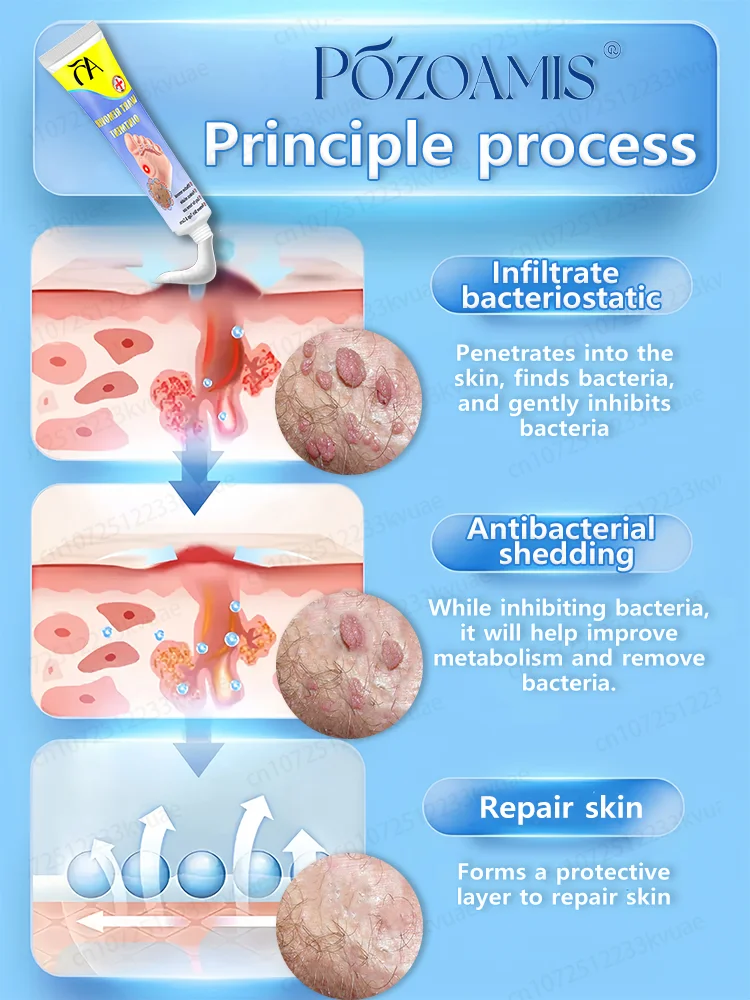 사마귀 제거 크림 HPV 생식기 사마귀 발바닥 사마귀