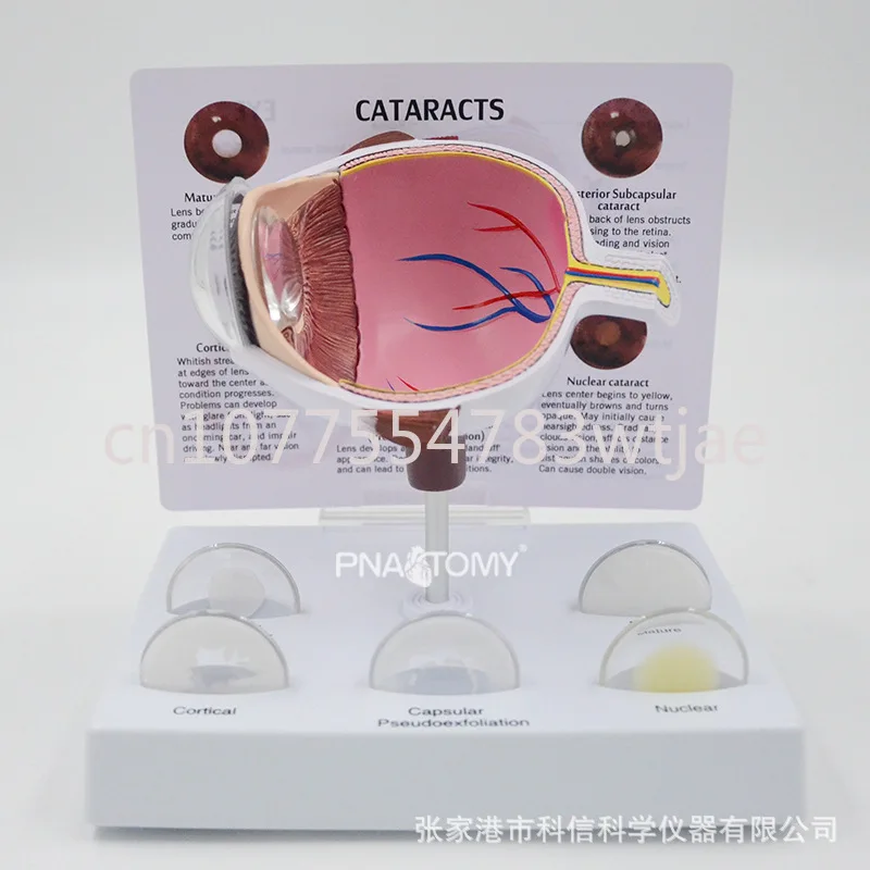 

Eye model pathology eye demonstration teaching tool