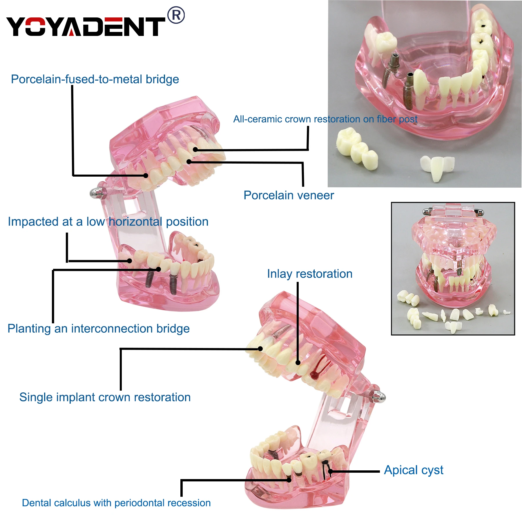 

Dental Teaching Studying Model Implant Teeth Model With Restoration Bridge Dentist Demo Model