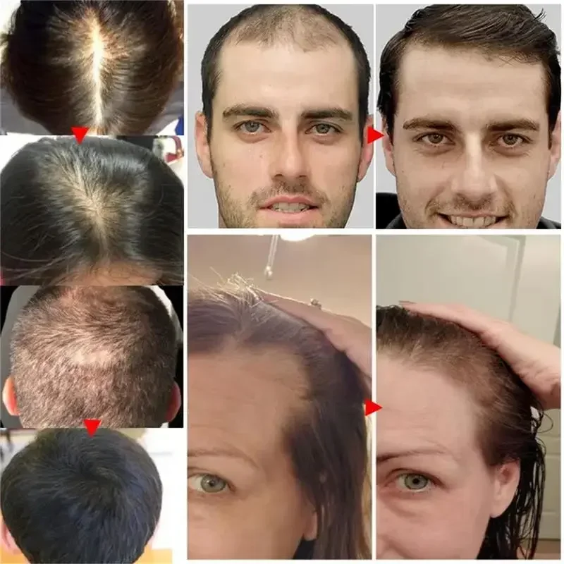 Sérum de croissance rapide des cheveux, huile essentielle Anti-perte de cheveux, réparation du cuir chevelu endommagé, femmes et hommes, soins Anti-calvitie