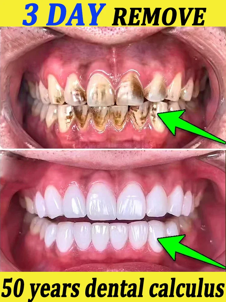 

Средство для удаления зубного камня, осветление зубов, удаление неприятного запаха изо рта, предотвращение пародонтита, уход за очисткой зубов