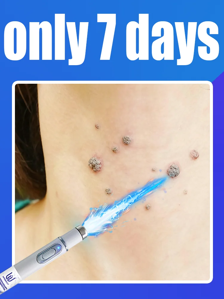 

The first generation of improved wart repair agent wart root fast