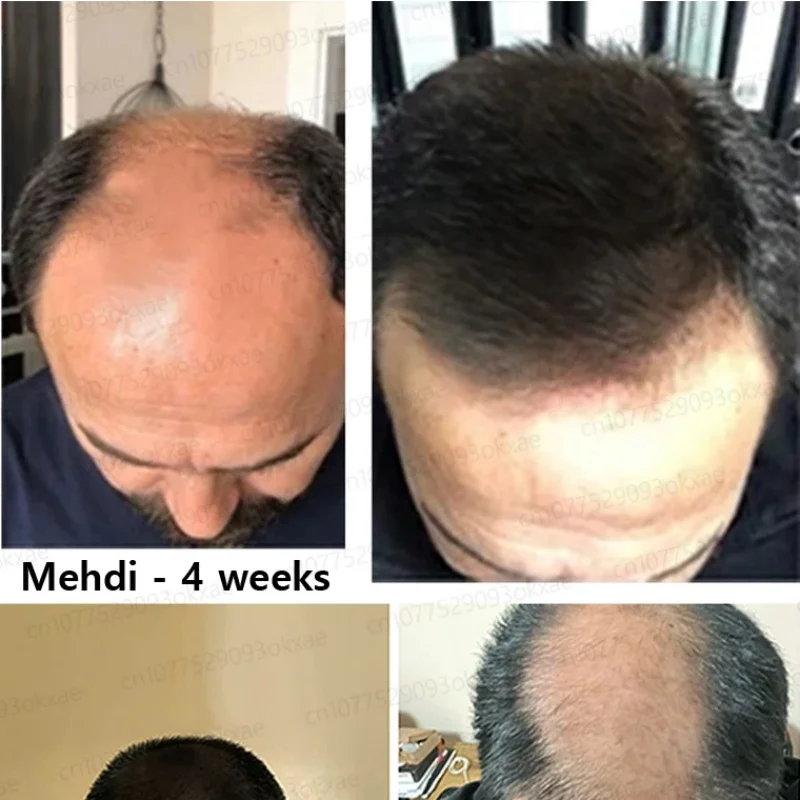 Parches de extracto de Saw Palmetto puro: suplemento mejorado para el crecimiento del cabello con Saw Palmetto para mujeres y hombres