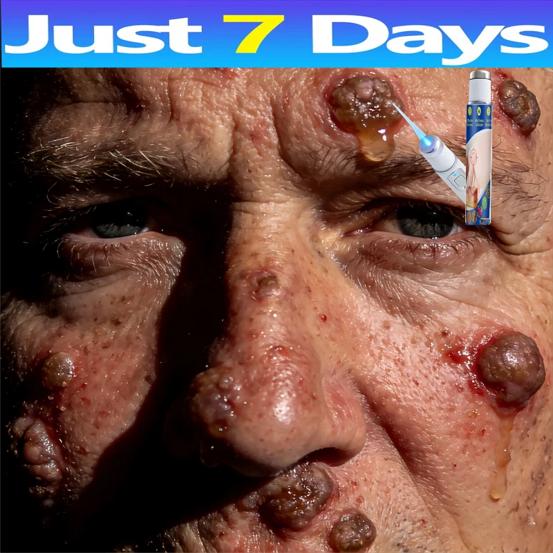 

Новый усовершенствованный синий лазерный прибор для удаления бородавок 2026 года