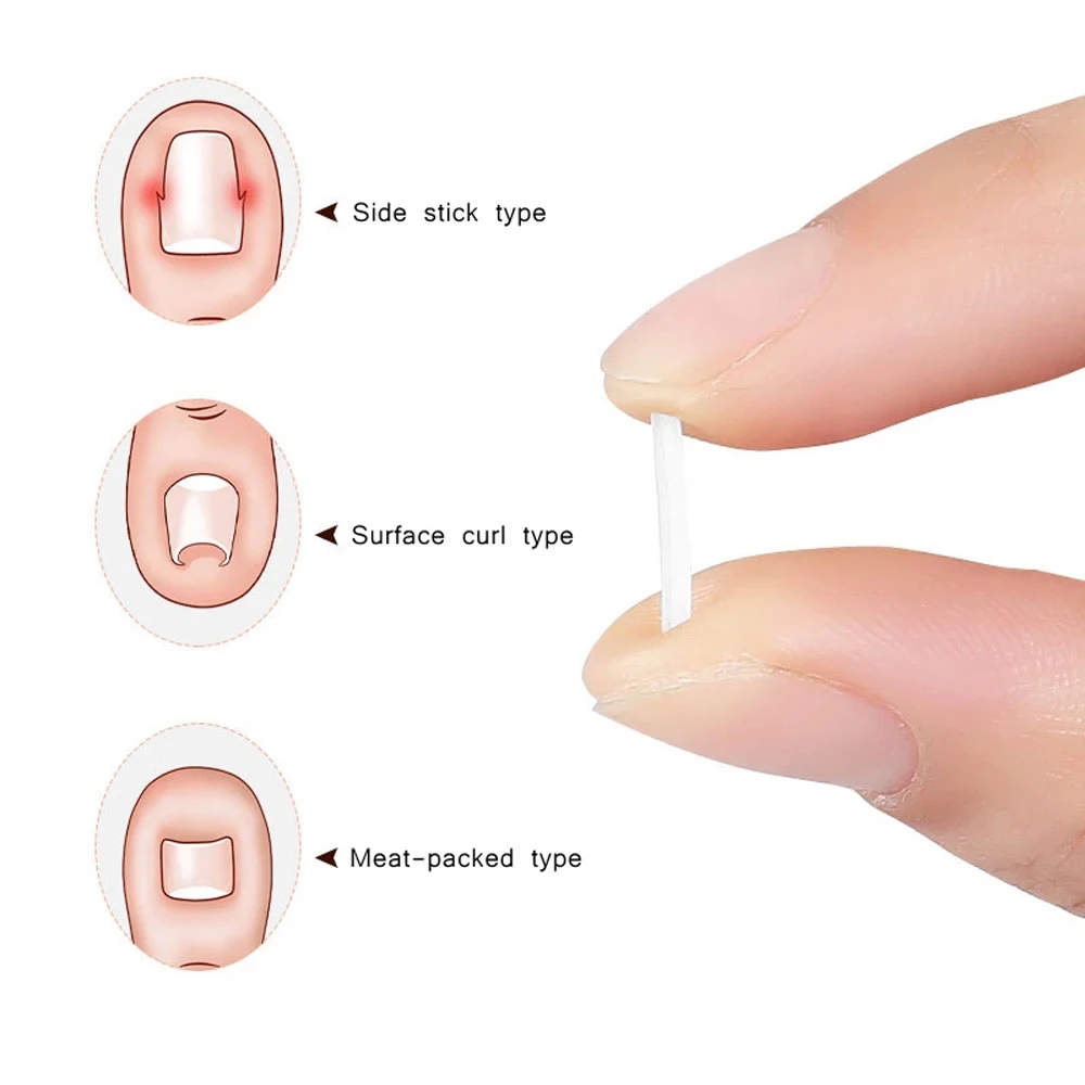 10 Stks/set Voetverzorging Tool Behandeling Bunion Paronychia Ingegroeide Nail Pad Groove Ortho Correctie Pads Teennagel Corrector