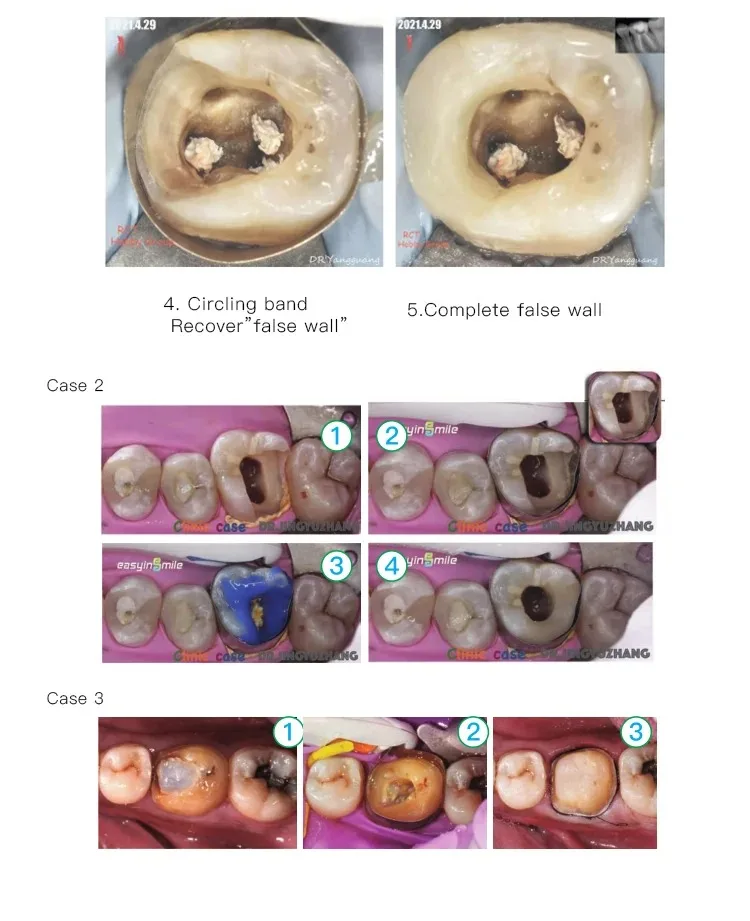 50PCS Dental Sectional Profect Matrix Band Halten Einstellen Vor Geformt 4,5/6,0 MM Ring System Werkzeug für zähne Füllung Materias – Detail 7