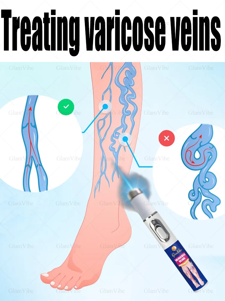 

"Varicose Veins: Causes, Symptoms, and Solutions for Healthy Legs"