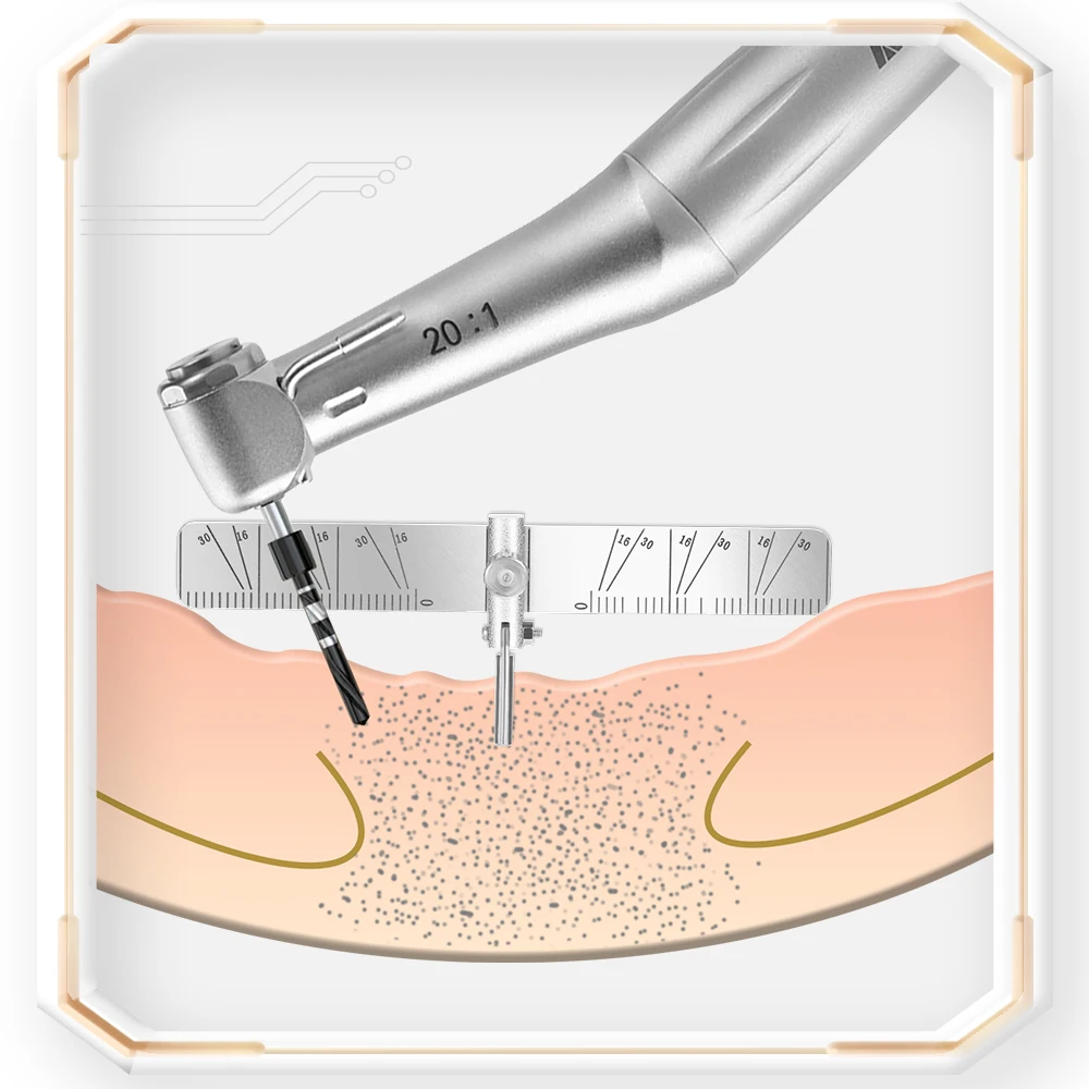 AZDENT-Guía de localización de implantes dentales, conjunto de regla de 2 ángulos, localizador de posicionamiento de plantación quirúrgica, instrumento de laboratorio Autoclavable