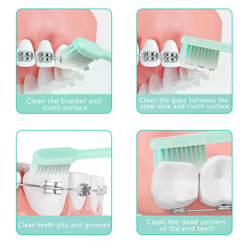1PCS Portable U-shaped Soft Bristled Toothbrush Folding Silver Ion Small Head Orthodontic Toothbrush For Cleaning Oral Care
