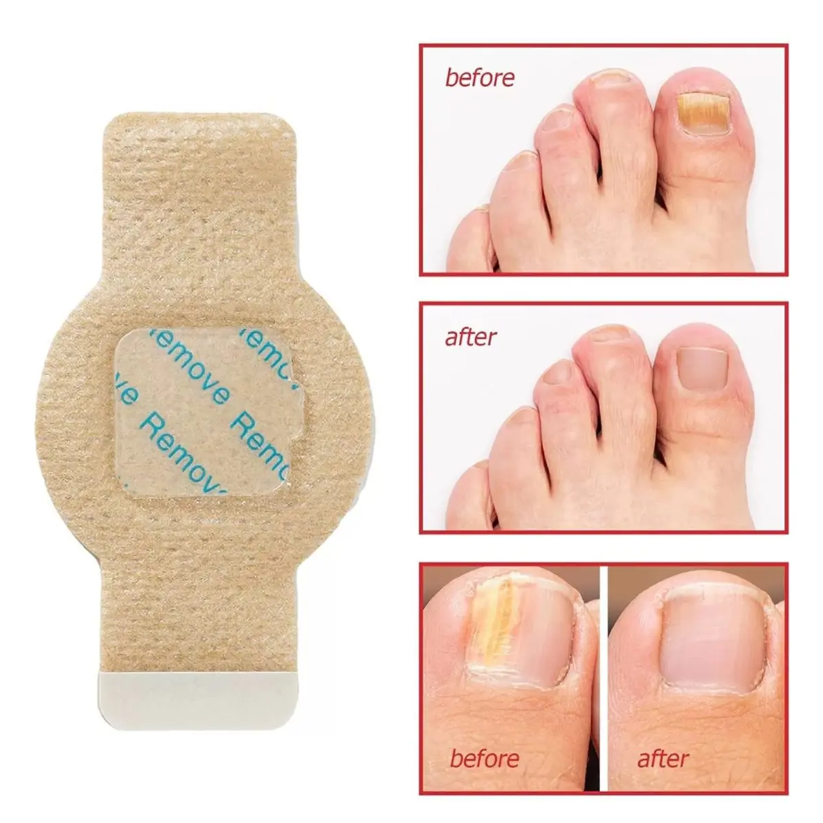 618 Mega Sale 210pcs Nail Repair Patches Toenail Fungu Patch Nail Ingrown Correction Sticker Paronychia Disposable Toe Patch