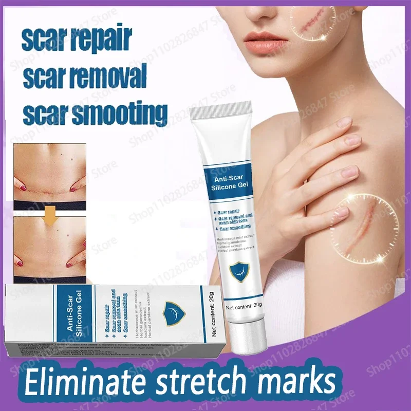 

Stretch Mark Remover Permanent Stretch Mark Removerstretch marks remove scars