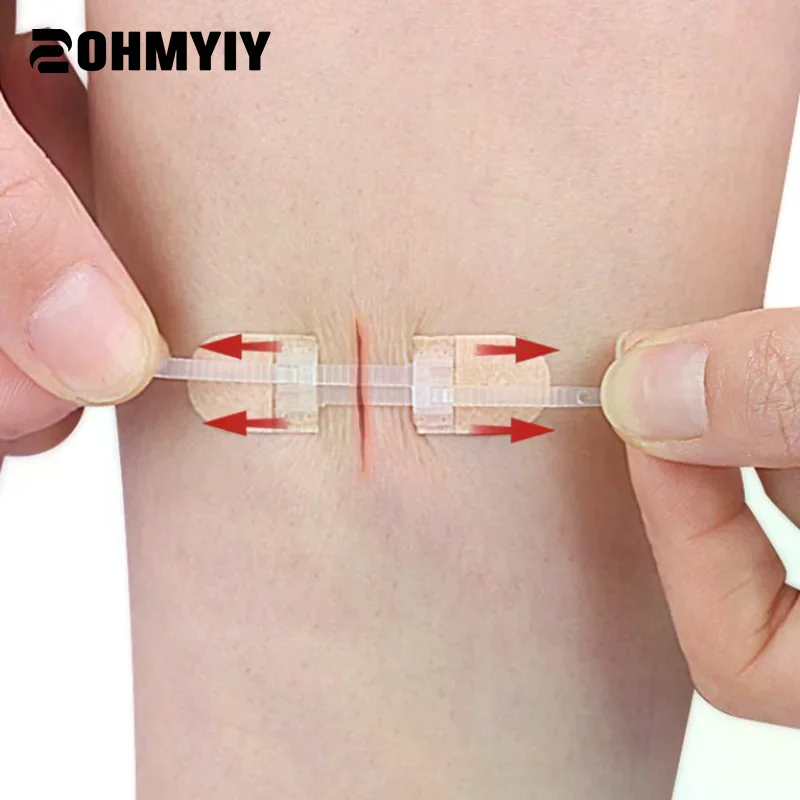 Patchs de fermeture de plaie avec fermeture éclair, 45x10mm, bandes de Sutures élastiques respirantes et sans couture pour le soin des plaies, Non tissées