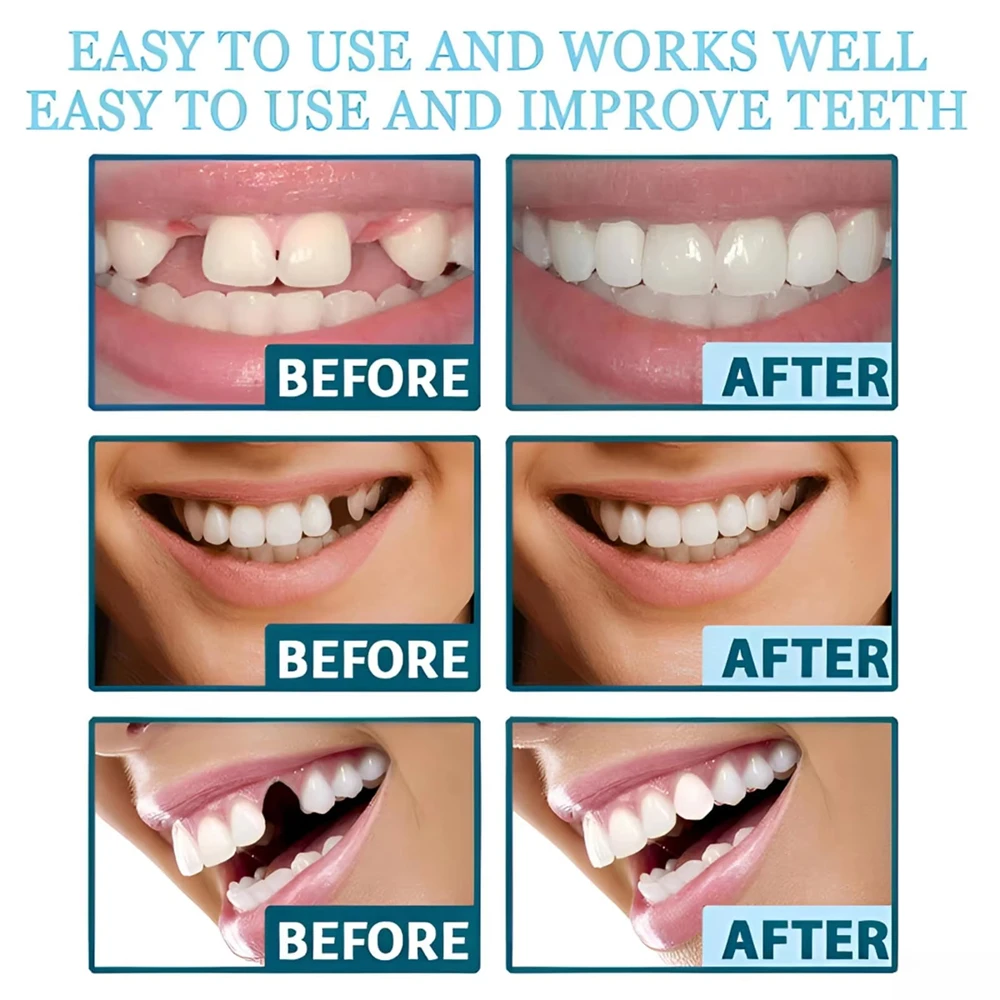 Instant Adjustable Snap-On Denture Kit | Medical-Grade Invisible Teeth for Gap Repair & Temporary Crowns
