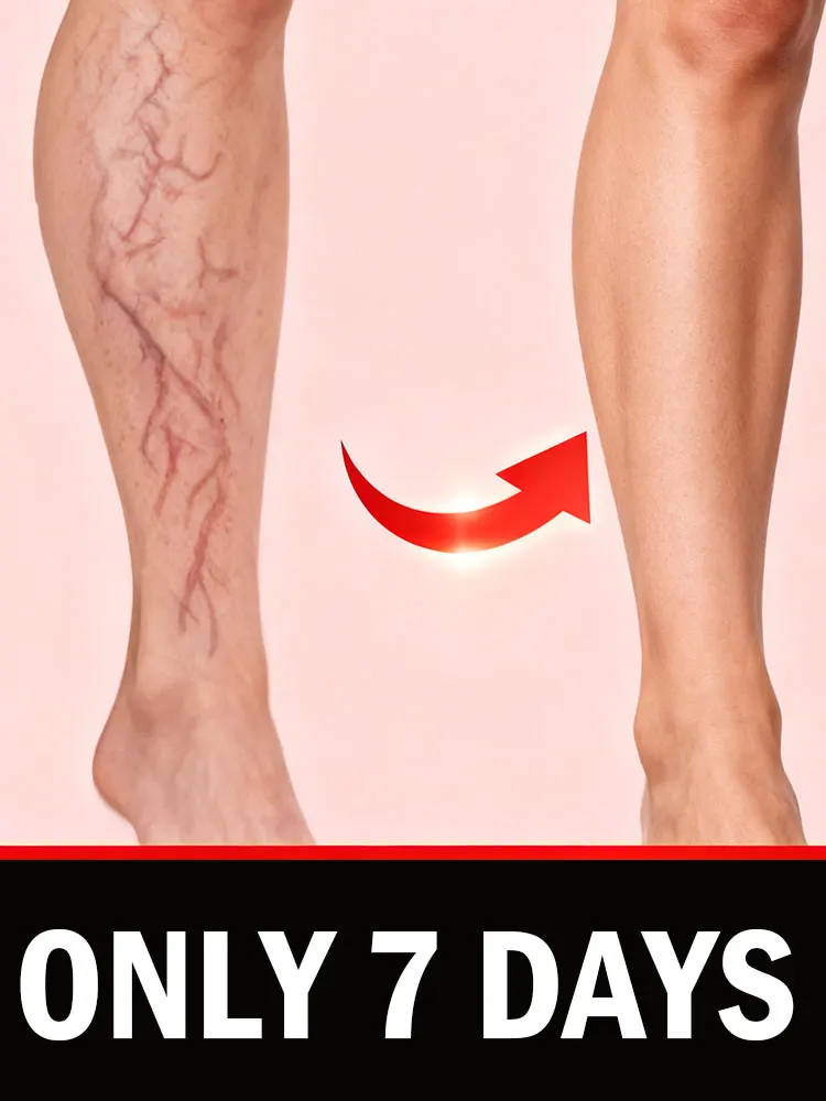 

Varicose Veins Pen Skin Care Product