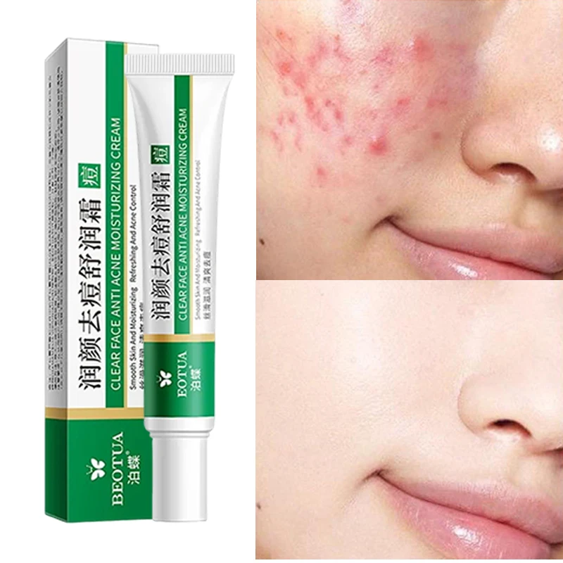 

Salicylic Acid Face Cream Acne Creams Mark Repair Firming Moisturizing Blackhead Remover Skincare Facial Cream Skin Care