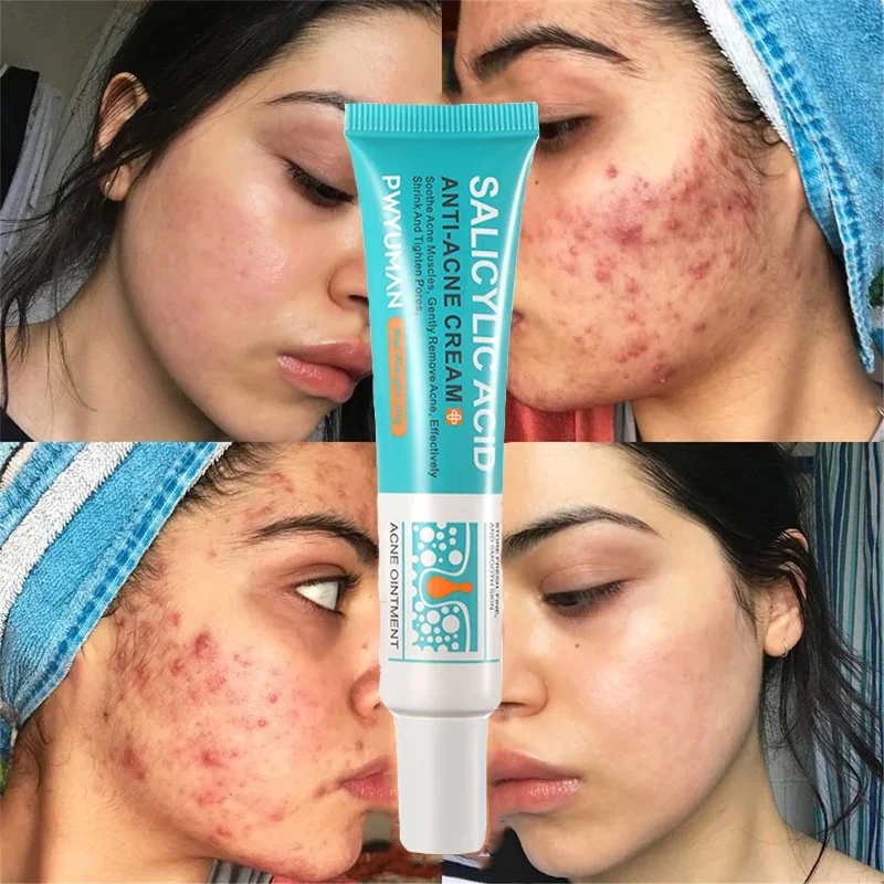 Salicylic Acid Acne Repair Face Cream Acne Scar Pimple Marks Remover Oil Control Whitening Smoothing Facial Skin Care Products