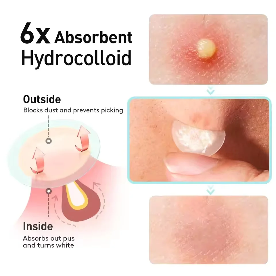 375 peças/caixa de remendos transparentes de hidrogel para acne, sem álcool, adesivos suaves e não irritantes para absorção de acne