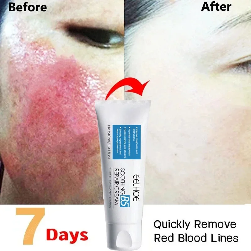 Facial Redness Repair Cream Improve Sensitive Skin Dryness Moisturizer Hydrating Sooth Lotion Removal Rosacea Korean Cosmetics