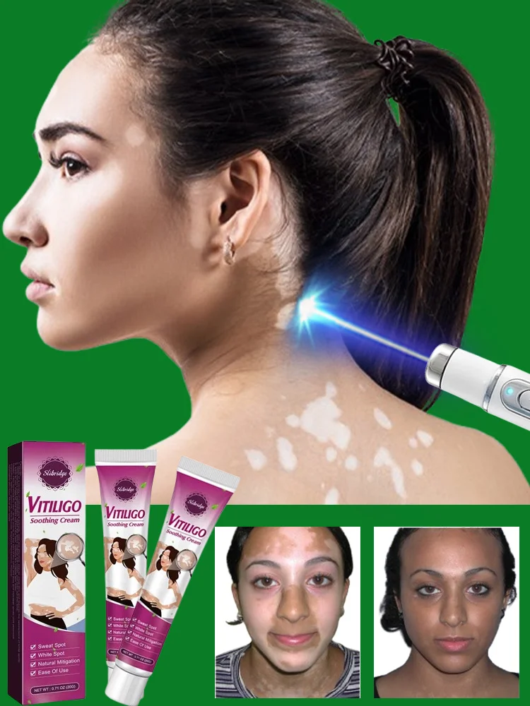 Crema Vitíligo Manchas Blancas