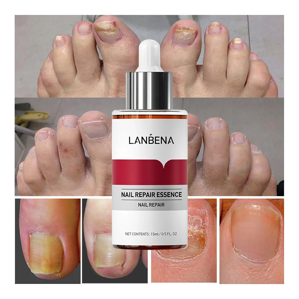 LANBENA soin des champignons supprimer l'onychomycose orteils nourrir éclaircir les mains pieds produit réparation approprié femmes ongles Pepair Essencs